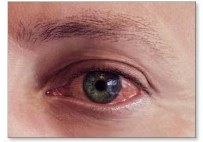 ALERTAN SOBRE NUEVO BROTE CONJUNTIVITIS