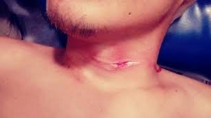 Hieren motoconchista durante una riña en San Marcos, PN recupera televisor había sido robado en Luperón