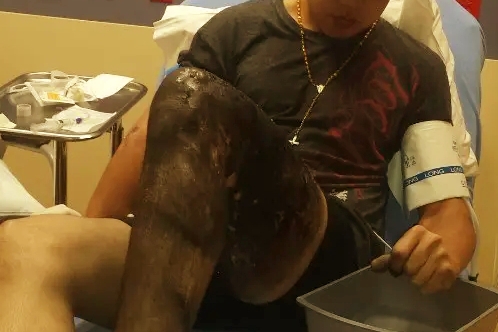 Joven sufre quemaduras en Puerto Plata tras incendiársele cigarrillo electrónico dentro del pantalón