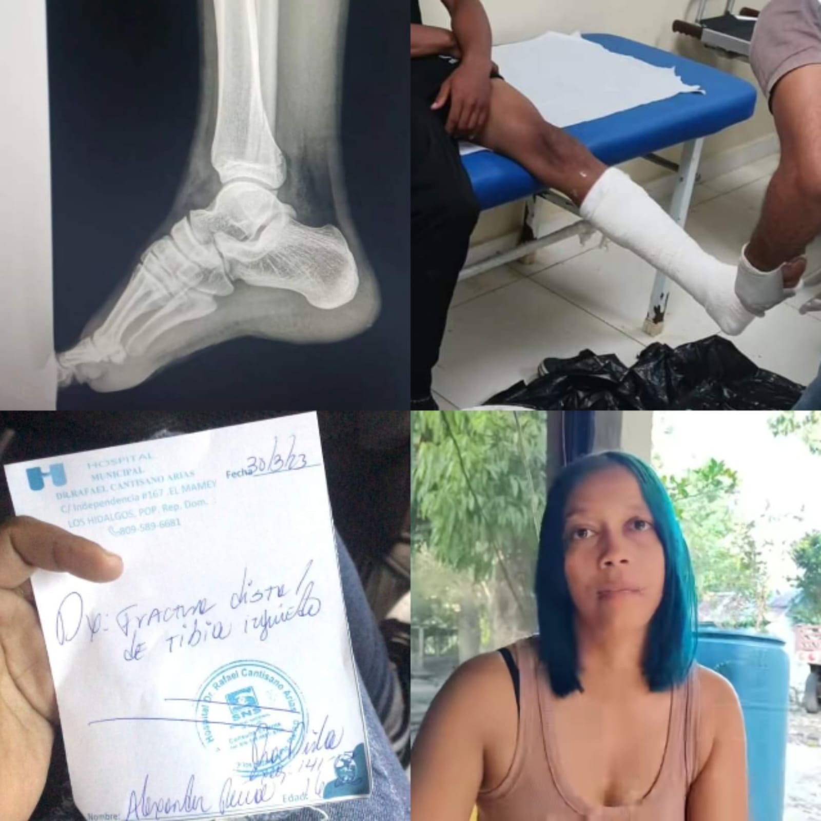 Madre denuncia su hijo fue golpeado hasta fracturarle una pierna en comunidad de Los Hidalgos   