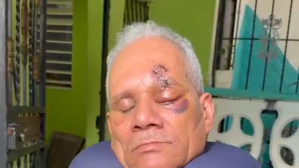 Hombre pierde un ojo tras ser agredido a botellazos por dos jóvenes en La Guáyiga, SDO