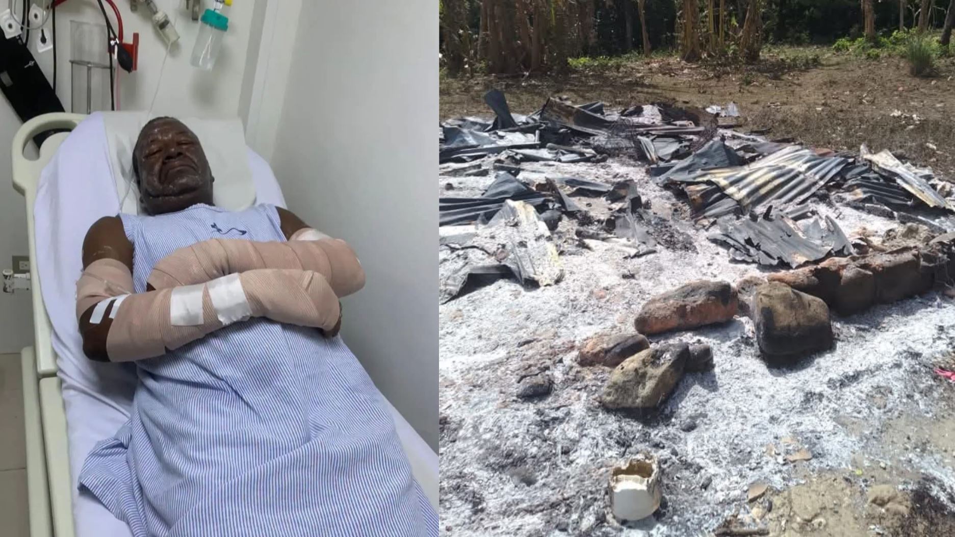 Hombre sufre quemaduras e incendios destruyen viviendas en localidades de Puerto Plata