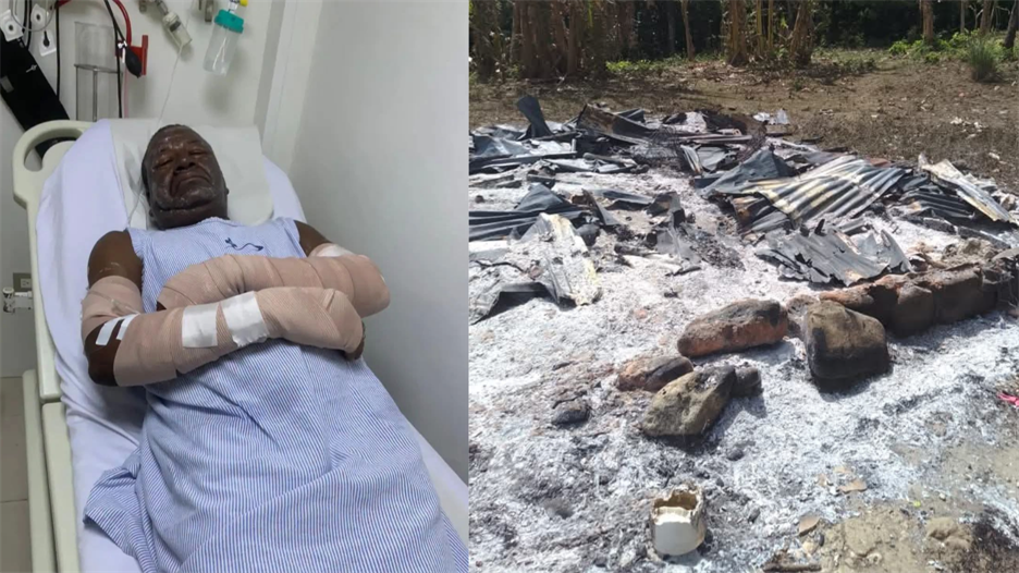Hombre sufre quemaduras e incendios destruyen viviendas en localidades de Puerto Plata